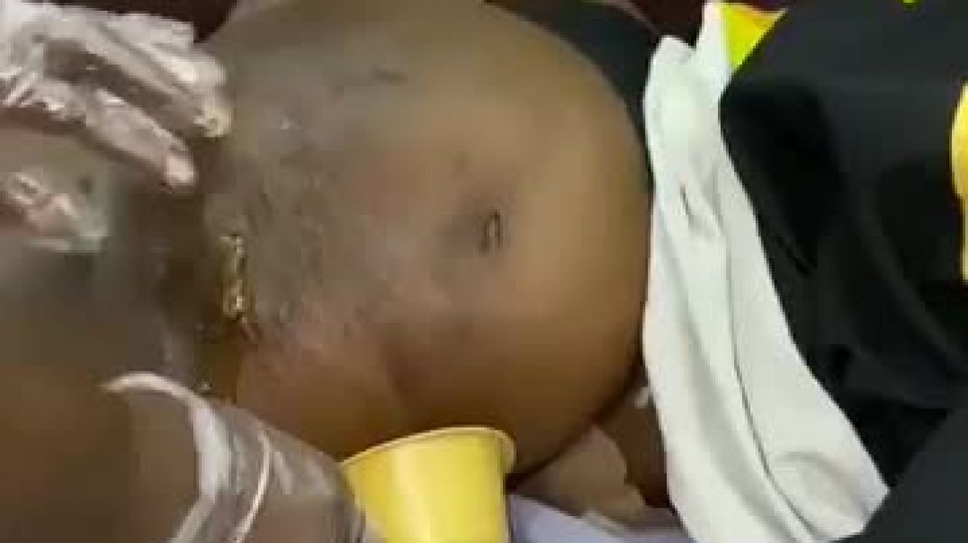 ⁣plastic surgery  gone wrong. Disturbing video shows a woman screaming out in pain as fat leaks out o
